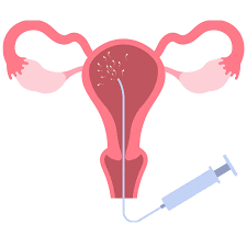 IUI (Intrauterine Insemination) - Specialist Gynaecology Treatment at First Care Clinic